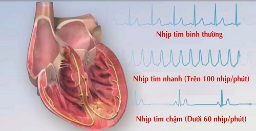 RỐI LOẠN NHỊP TIM VÀ NHỮNG BIẾN CHỨNG